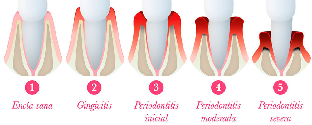 Enfermedades periodontales